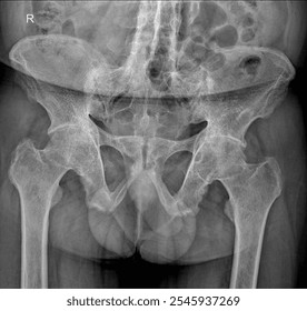 High-Resolution X-Rays of Pelvic Bone, Lumbar Spine, and Hip Joint for Clinical Review - Powered by Shutterstock