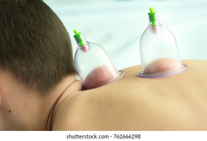 Hijama - The Treatment Of Bloodletting.