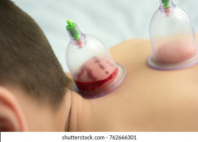 Hijama - The Treatment Of Bloodletting.