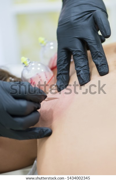 Hijama - the treatment of bloodletting. Attached\
vacuum cup. Scarification\
process.