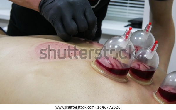 Hijama Treatment Bloodletting Attached Vacuum Cup arkistokuva (muokkaa nyt)...