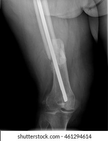 Hip fracture after surgery