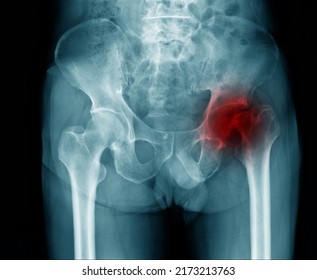 Hip Fracture At Intertrochanteric Of Femur Bone