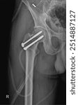 Hip Fracture Stabilization with Screws: A Radiographic Evaluation and Orthopedic Approach