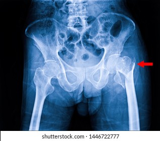 Hip Fracture Xray Photo Image. X-ray Of Hip Joint For Elderly Patient Who Falling In The House. Bone Process To Blue Tone And Fracture Area Marked In Red Color.