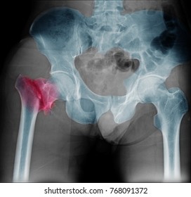 Hip Fracture Xray Photo Image. X-ray Of Hip Joint For Elderly Patient Who Falling In The House. Bone Process To Blue Tone And Fracture Area Marked In Red Color.