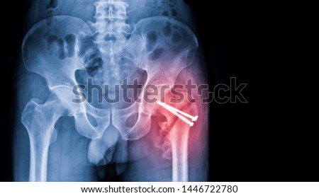 Hip fracture x-ray photo image. X-ray of hip joint for elderly patient who falling in the house. Postoperative and showing femoral neck fracture and fix by hip compression screw.