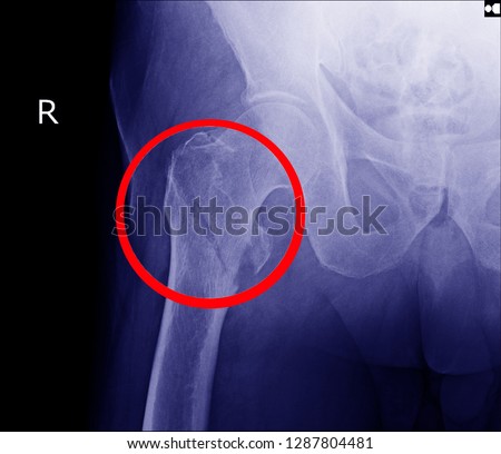  Hip fracture xray photo image.X-ray of hip joint fracture for elderly patient who falling in the step.