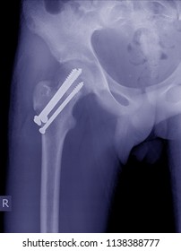 Hip Fractures Post Operation Screw Internal Stock Photo 1138388777 ...