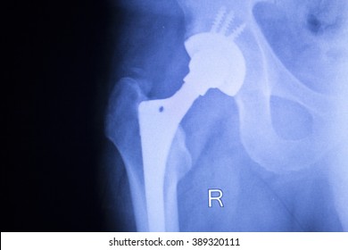 Hip Joint Meniscus Orthopedic Titanium Metal Replacement Implant Xray Scan Test Results.