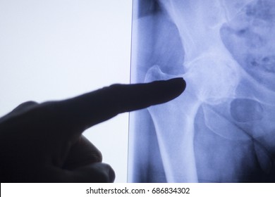 Hip Joint X-ray Test Scan Results Of Old Aged Person With Arthritis And Joints Pain.