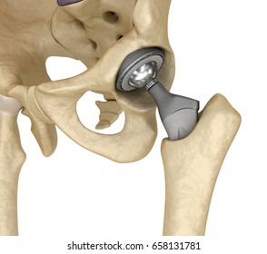 Hip Replacement Stock Images, Royalty-Free Images & Vectors | Shutterstock