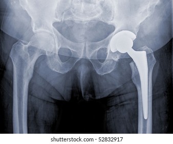 Hip Replacement Surgery, Good Outcome