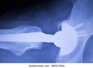 Hip Replacement Xray Orthopedic Medical X-ray Traumatology Test Scan Image Of Old Age Senior Adult.