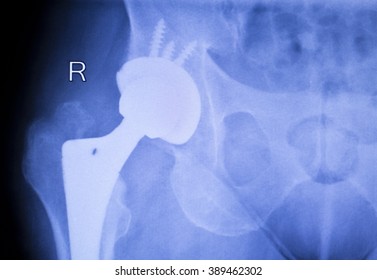 Hip Replacement Xray Orthopedic Medical X-ray Traumatology Test Scan Image Of Old Age Senior Adult.