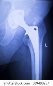 Hip Replacement Xray Orthopedic Medical X-ray Traumatology Test Scan Image Of Old Age Senior Adult.