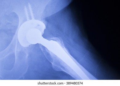 Hip Replacement Xray Orthopedic Medical X-ray Traumatology Test Scan Image Of Old Age Senior Adult.