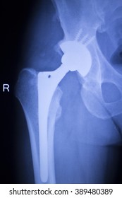 Hip Replacement Xray Orthopedic Medical X-ray Traumatology Test Scan Image Of Old Age Senior Adult.