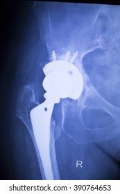 Hip Replacement Xray Orthopedic Medical X-ray Traumatology Test Scan Image Of Old Age Senior Adult.