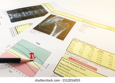 Hip and Spine Bone mineral density (BMD) DEXA densitometry hip scan. Osteopenia present, frequent precursor to osteoporosis on pin point. - Shutterstock ID 1512016055