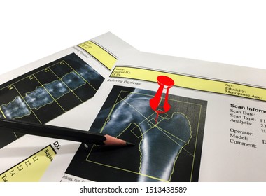 Hip and Spine Bone mineral density (BMD) DEXA densitometry hip scan. Osteopenia present, frequent precursor to osteoporosis on pin point.Medical healthcare concept. - Shutterstock ID 1513438589