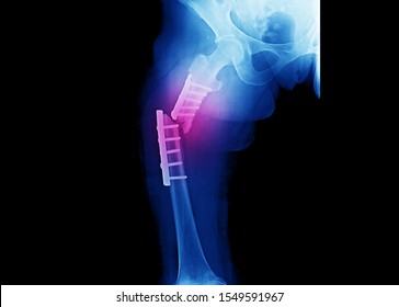 Rayos x de cadera y muslo que muestran fractura cerrada en el eje del fémur derecho. El paciente ha sido sometido a fijación con placa y tornillos. La imagen muestra la falla del implante o la placa rota en el lugar de la fractura.