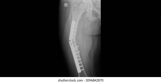 Una radiografía de cadera y muslo que muestra fractura cerrada en el eje del fémur derecho. El paciente tiene fijación con placa y tornillos. La imagen muestra la falla del implante o la placa rota en el lugar de la fractura.