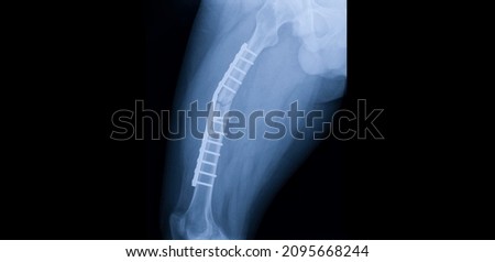 A hip and thigh x-ray showing closed fracture at shaft of right femur. The patient has fixation with plate and screws. The image shows implant failure or broken plate at the fracture site.