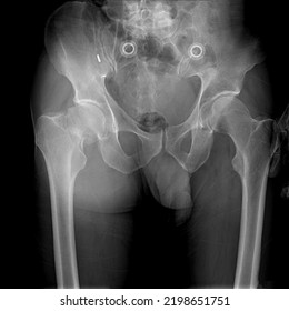 Hip X Ray Pelvis And Femur Radiology And Diagnosis Imagining 