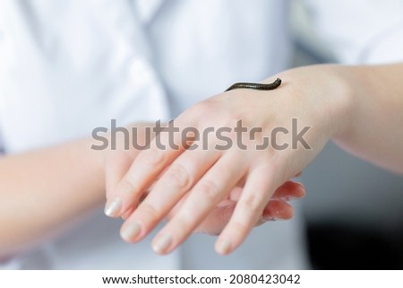 Hirudotherapy procedure. The doctor holds the leech, close-up