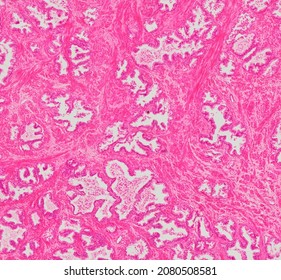 Histological section of the prosatate gland stained with hematoxylin and eosin.