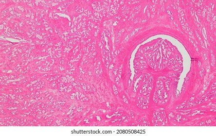 Histological Section Of The Prostate Gland Stained With Hematoxylin And Eosin.