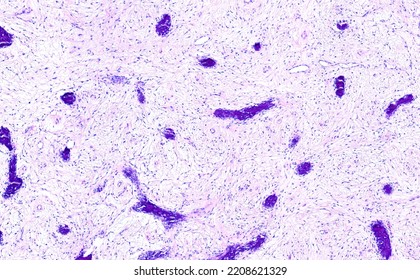 Histology Of Bone, Fibrous Osteodystrophy Pathology