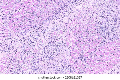 Histology of bovine heart, myocarditis pathology - Shutterstock ID 2208621327
