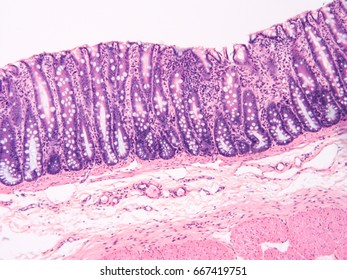 Photomicrograph Lymphocytic Colitis Type Microscopic Colitis Stock ...