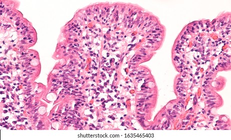 Histology Of Duodenal Biopsy From Patient With Bloating And Diarrhea From Celiac Diseae (sprue, Gluten Sensitive Enteropathy), With Moderate Villous Blunting And Increased Intraepithelial Lymphocytes.