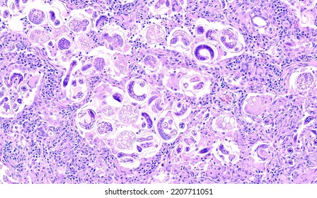 Histology of feline lung, Aelurostrongylus abstrusus parasite larvae and eggs within alveoli, inflammation - Shutterstock ID 2207711051