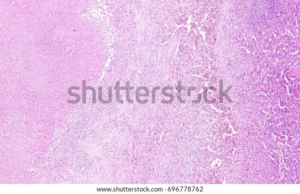 Histology Human Tissue Show Spleen Infarction Stock Photo 696778762 ...