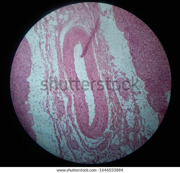 Histology slide\
image of lymphogranulomatosis pathology under light microscope with\
hematoxylin eosin stain\

