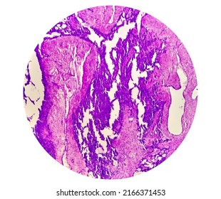 Histology Test Of Intra-cranial Space Occupying Lesion(biopsy): Brain Cancer, Metastatic Papillary Adenocarcinoma, Papillary Meningioma, Show Brain Tissue, Necrosis Present. Malignant Tumor