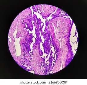 Histology Test Of Intra-cranial Space Occupying Lesion(biopsy): Brain Cancer, Metastatic Papillary Adenocarcinoma, Papillary Meningioma, Show Brain Tissue, Necrosis Present. Malignant Tumor