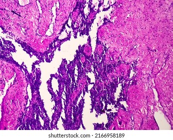 Histology Test Of Intra-cranial Space Occupying Lesion(biopsy): Brain Cancer, Metastatic Papillary Adenocarcinoma, Papillary Meningioma, Show Brain Tissue, Necrosis Present. Malignant Tumor