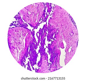 Histology Test Of Intra-cranial Space Occupying Lesion(biopsy): Brain Cancer, Metastatic Papillary Adenocarcinoma, Papillary Meningioma, Show Brain Tissue, Necrosis Present. Malignant Tumor