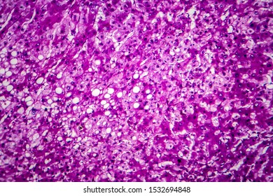 Histopathology Of Alcoholic Hepatitis, Light Micrograph, Photo Under Microscope