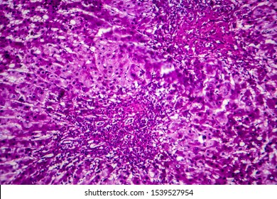 Histopathology Of Alcoholic Hepatitis, Light Micrograph, Photo Under Microscope