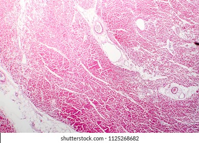 81 Myocardial Necrosis Images, Stock Photos & Vectors | Shutterstock