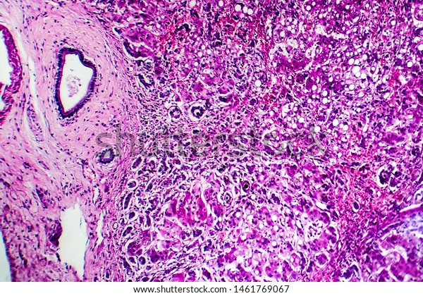 Histopathology Biliary Liver Cirrhosis Light Micrograph Stock Photo ...