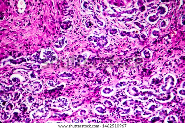 Histopathology Biliary Liver Cirrhosis Light Micrograph Stock Photo ...