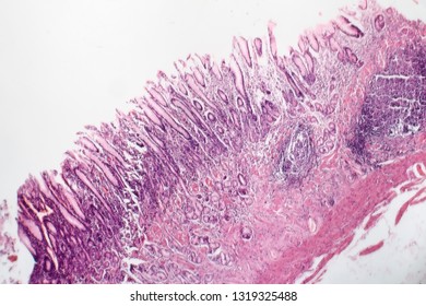 23 Atrophic gastritis Images, Stock Photos & Vectors | Shutterstock