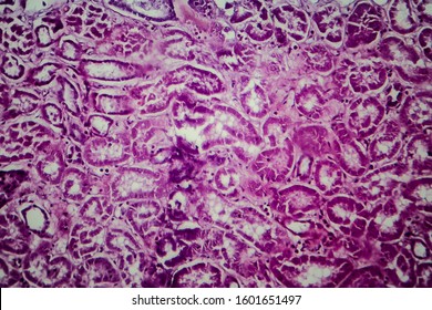 Histopathology Diffuse Sclerosing Glomerulonephritis Light Micrograph ...